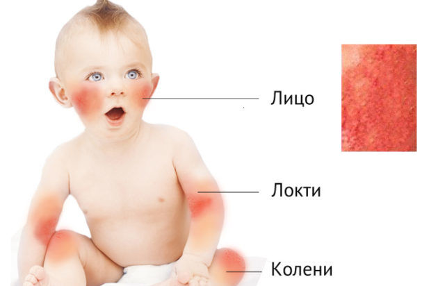 Аллергия у грудного ребенка: причины и симптомы